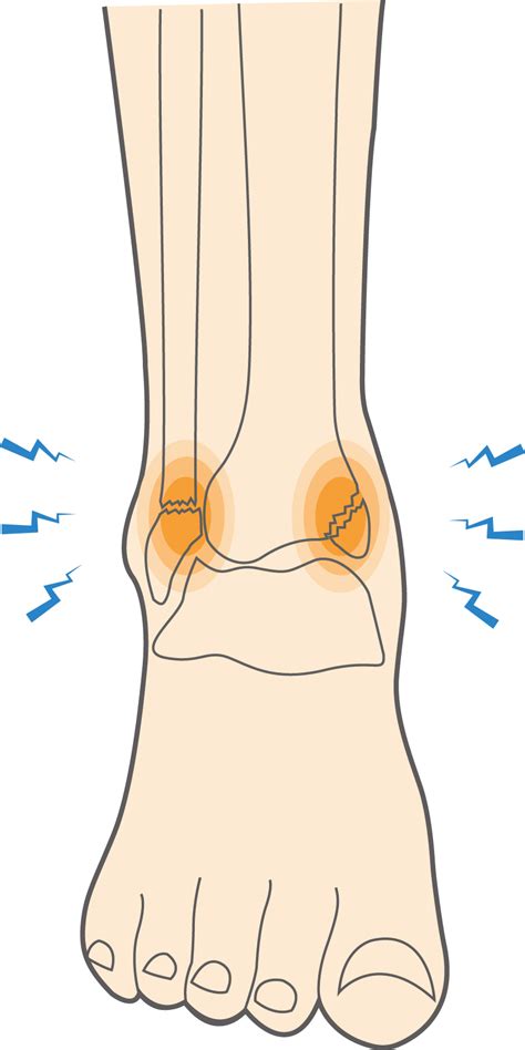 What are Ankle Fractures or Broken Ankle Injuries? - Upswing Health