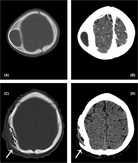 Pre‐ and postoperative images. (A) Axial bone view CT scan of the ...