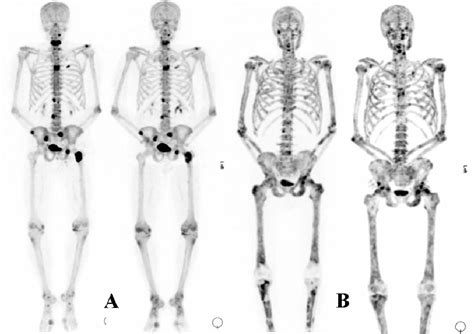 Bone Metastasis Cancer - Symptoms, Life Expectancy, Treatment