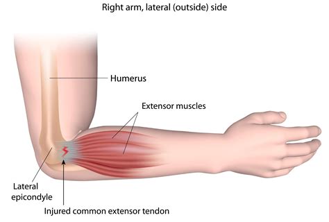 Tennis Elbow - Lateral Epicondylitis - Raleigh Hand Surgery — Joseph J. Schreiber, MD