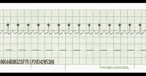 Float Nurse: Practice EKG Strips 418