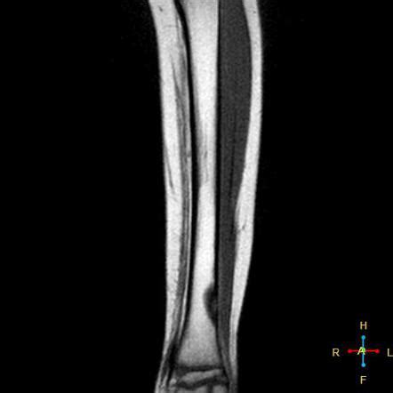 Fibrous cortical defect - on MRI | Radiology Case | Radiopaedia.org