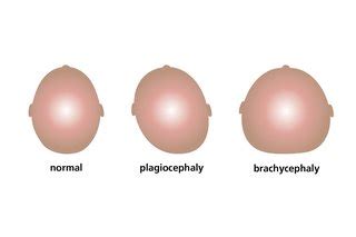 Plagiocephaly and brachycephaly (flat head syndrome) - NHS