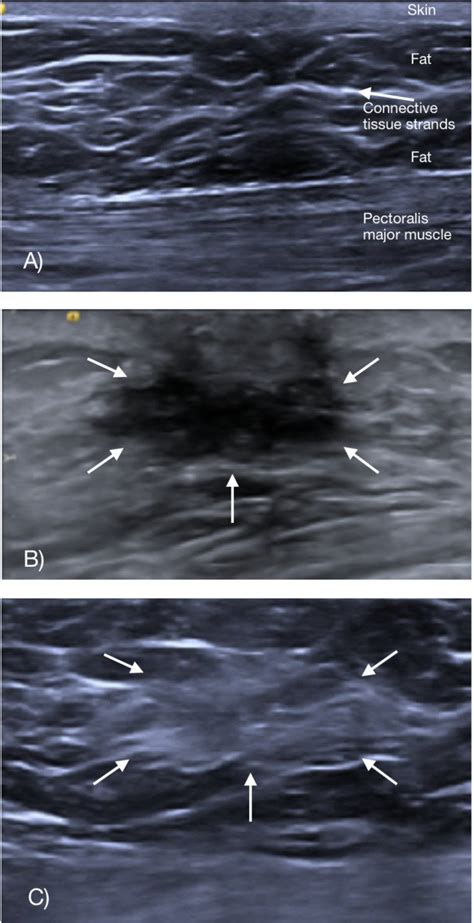 Ultrasound images of the retroareolar region. A) Normal male breast ...