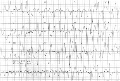 Bidirectional Ventricular Tachycardia (BVT) • LITFL • ECG Library