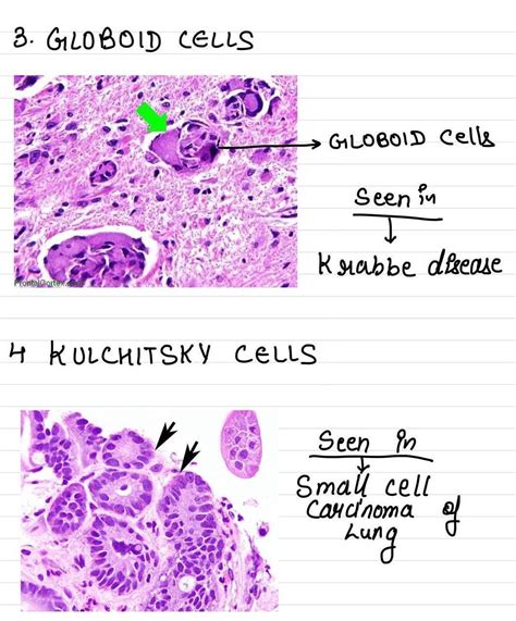 Globoid Cells and Kulchitsky Cells - MEDizzy