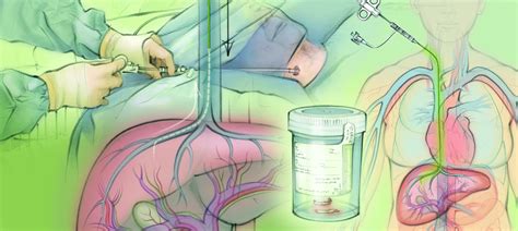 Transjugular Liver Biopsy — The Interventional Initiative