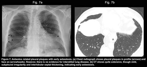 Causes Of Unilateral Transudative Pleural Effusion