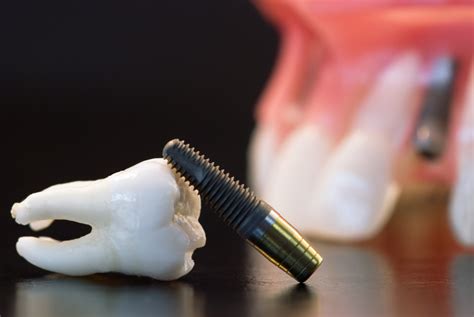 Dental Implants Procedure | Cosmetic Dentistry | Vancouver