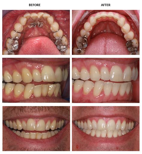 Inman Aligner before and after pictures - Inman Aligner