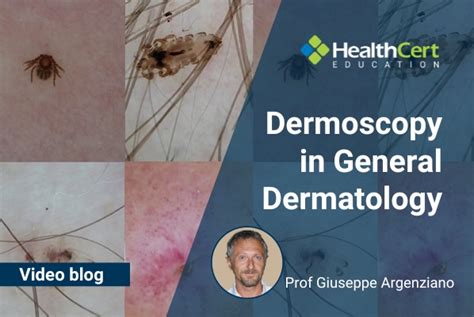 Dermoscopy in general dermatology