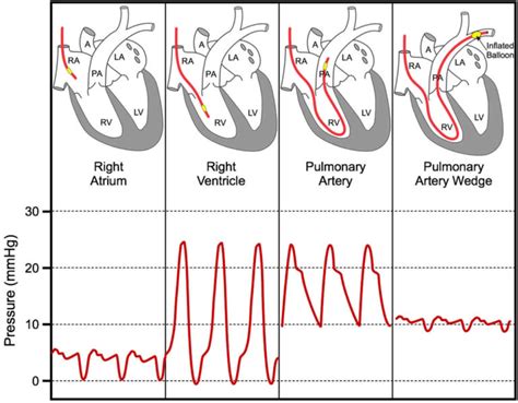 Pulmonary capillary wedge pressure & pulmonary artery wedge pressure