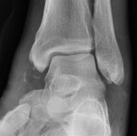 Avulsion fractures: medial and lateral malleoli | Image | Radiopaedia.org