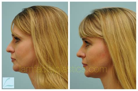 Before and After Rhinoplasty #rhinoplasty #nosejob #cosmeticnose #drsamlam #lfpsurgery ...