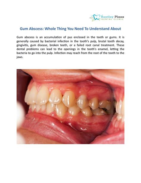 Gum abscess: whole thing you need to understand about by Bentley plaza dental pty ltd - Issuu