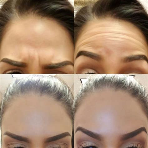 Botox before & after - 3 week difference at Mystique Medical Spa in ...