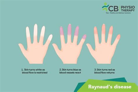 What Is Raynaud’s Disease?, Symptoms, Causes, Diagnosis & Physiotherapy ...