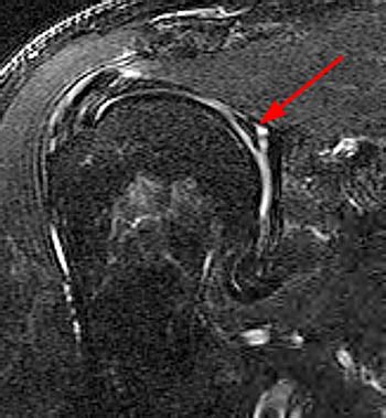 Outcomes for Type II SLAP Tear Revision Surgery | Brian Schiff’s Blog