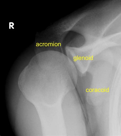 View Anatomy Shoulder X Ray Pics