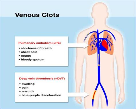 What is a blood clot? | UNC Hemophilia and Thrombosis Center