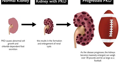 treatment for kidney disease: Stages of Polycystic Kidney Disease (PKD)