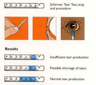 Schirmer’s test | Epomedicine