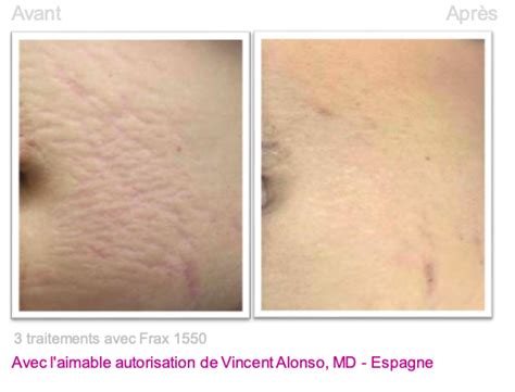 Traitement des vergetures par laser - Dermo Laser Lyon