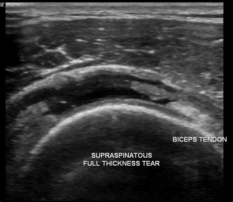 Ultrasound Leadership Academy: Intro to Shoulder Evaluation — EM Curious