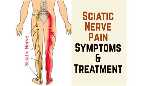 Tens Unit Placement Sciatica Pain