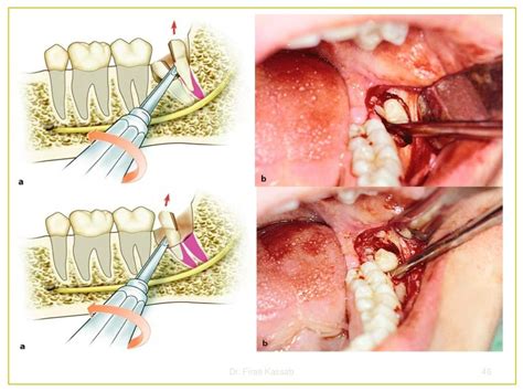 Surgical extraction of impacted teeth i