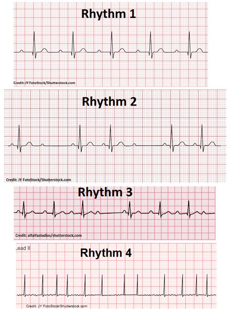 Atrial Fibrillation (A-Fib) Quiz Questions ECG/EKG