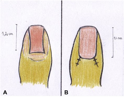 Chronic paronychia treatment: Square flap technique - Journal of the American Academy of Dermatology