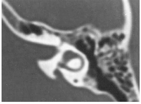 Axial TC showing enlarged vestibular aqueduct in a patient affected by... | Download Scientific ...