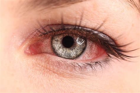 7 Pink Eye Symptoms You Shouldn't Ignore | The Healthy