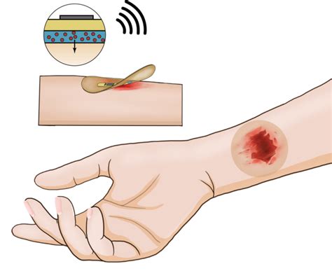 Wireless smart bandage provides new insights | EurekAlert!