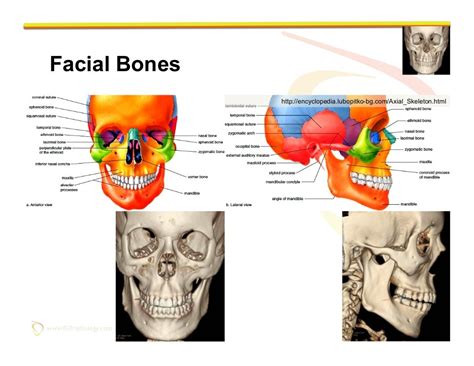 Imaging of Facial Trauma