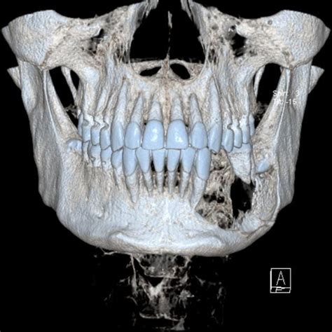 Ameloblastoma | Radiology Case | Radiopaedia.org: 37 year-old member of ...