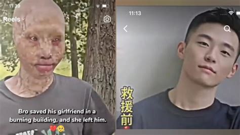 Kim Yosh Accident: Face Burn Viral Video On TikTok