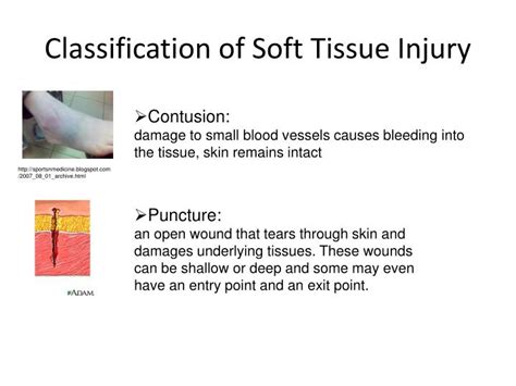 PPT - Soft Tissue Injury PowerPoint Presentation - ID:1634436