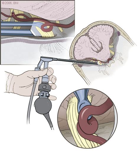 Neurosurgical Interventions | Nurse Key