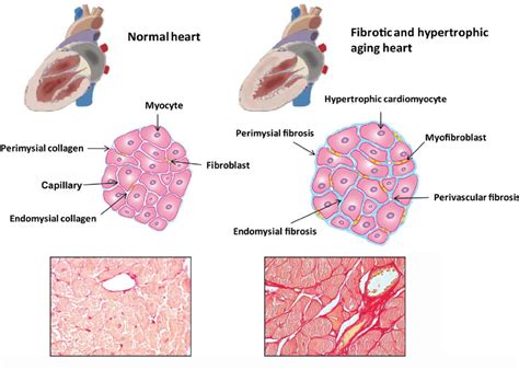 Fibrosis of the aging heart. Cardiac aging is associated with... | Download Scientific Diagram