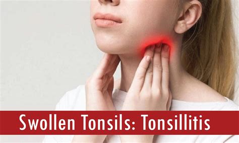 Swollen Tonsils - The Wellness Dot