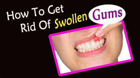 How Treat Swollen Gums Naturally at Home || Home Remedies for Gums Swelling - YouTube