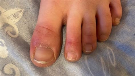 Pediatricians warned about 'COVID toes' in children infected with COVID-19 | CTV News