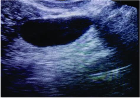 Ultrasound Scan appearance of a huge Left sided multilocular adnexal ...