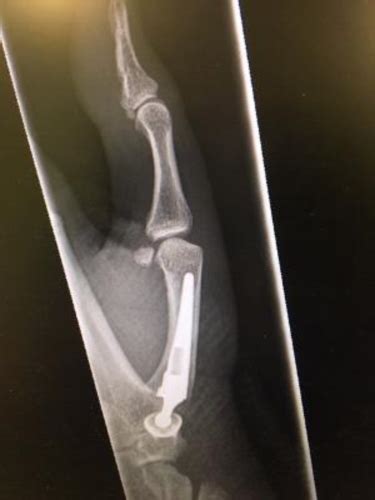 Thumb Joint Artificial Replacement | Arthritis | Forums | Patient