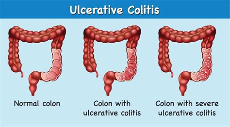 Ulcerative Colitis Symptoms