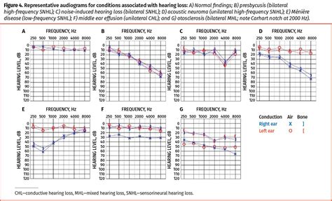 Conductive Vs Sensorineural Hearing Loss Audiogram