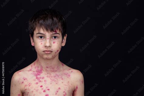 Chickenpox varicella scabies, sick child boy 8 years old with skin disease. Chickenpox varicella ...