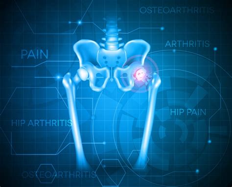 Complications after Total Hip Replacement, Hip Surgery